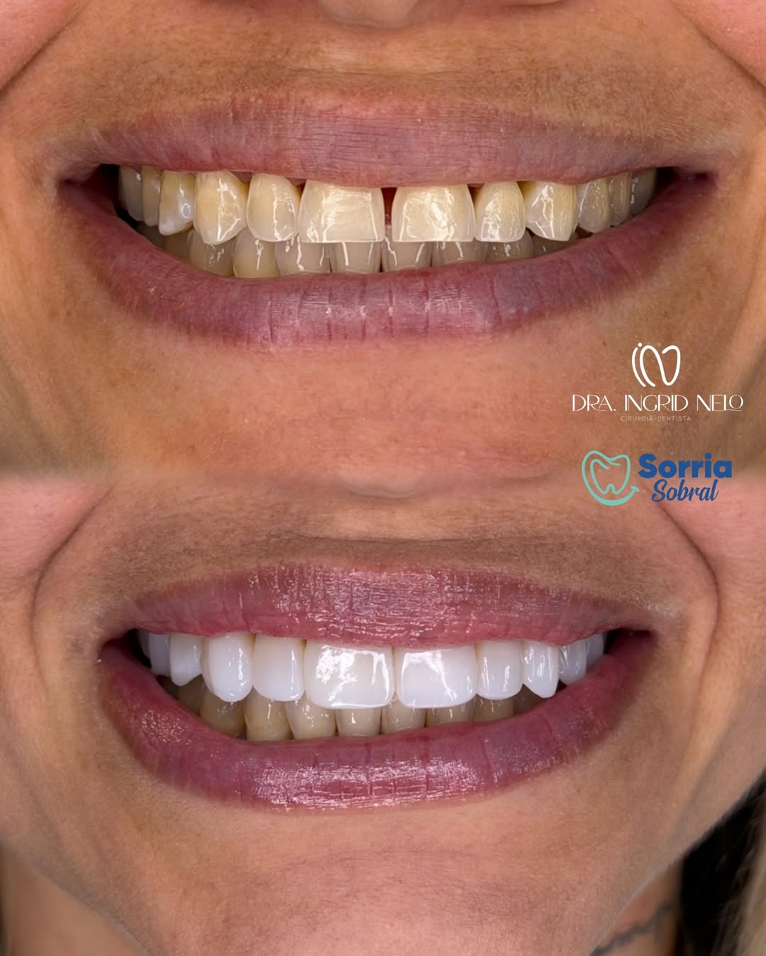 Antes e depois — Estética Dental