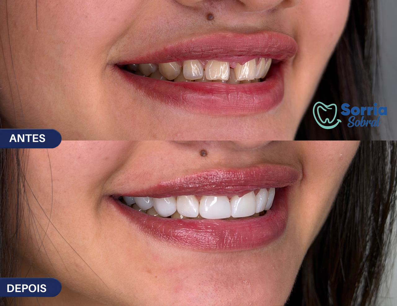 Antes e depois — Estética Dental