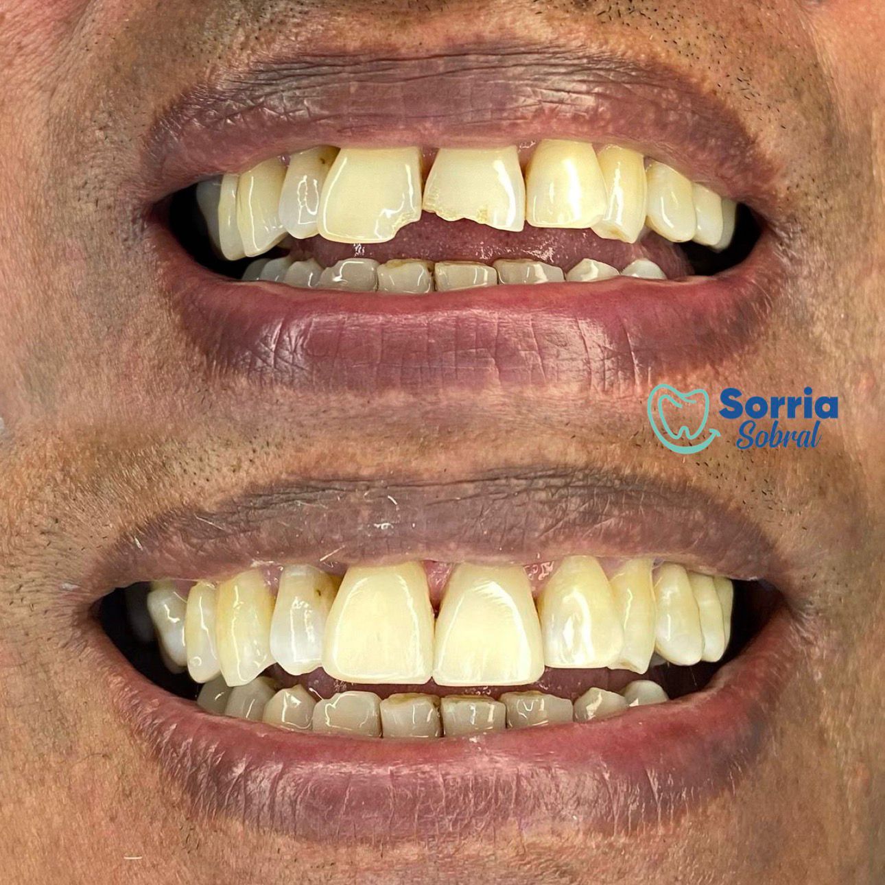 Antes e depois — Sorriso Harmonizado
