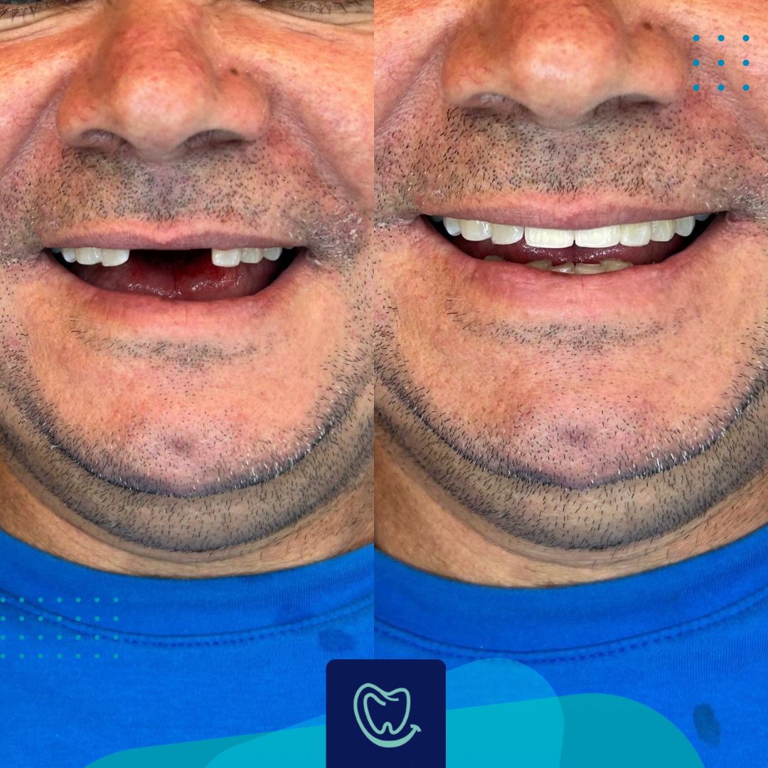Antes e depois — Reabilitação Estética