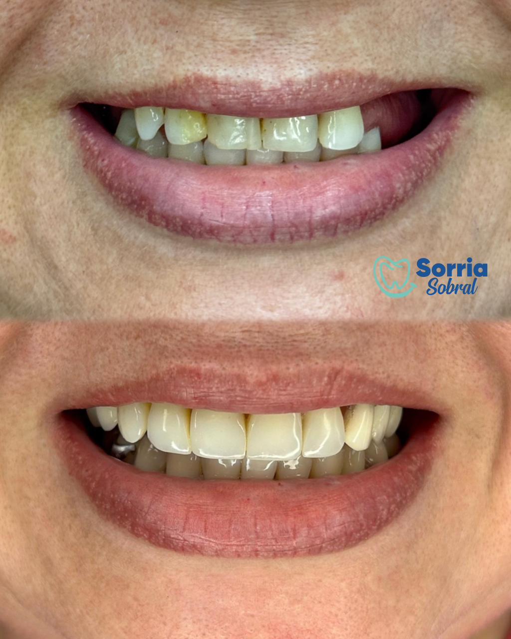 Antes e depois — Reabilitação com prótese e facetas